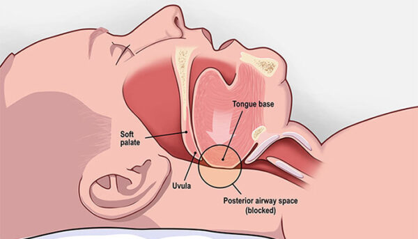 ORAL AIRWAY - Image 4