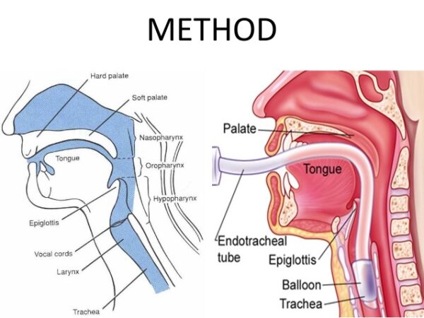 ENDOTRACHEAL TUBE - Image 2