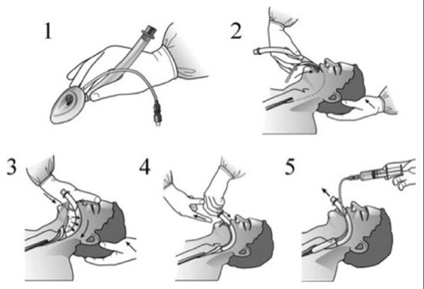 LMA (Laryngeal Mask Airway) - Image 3