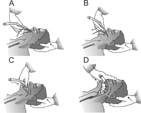 LMA (Laryngeal Mask Airway) - Image 6